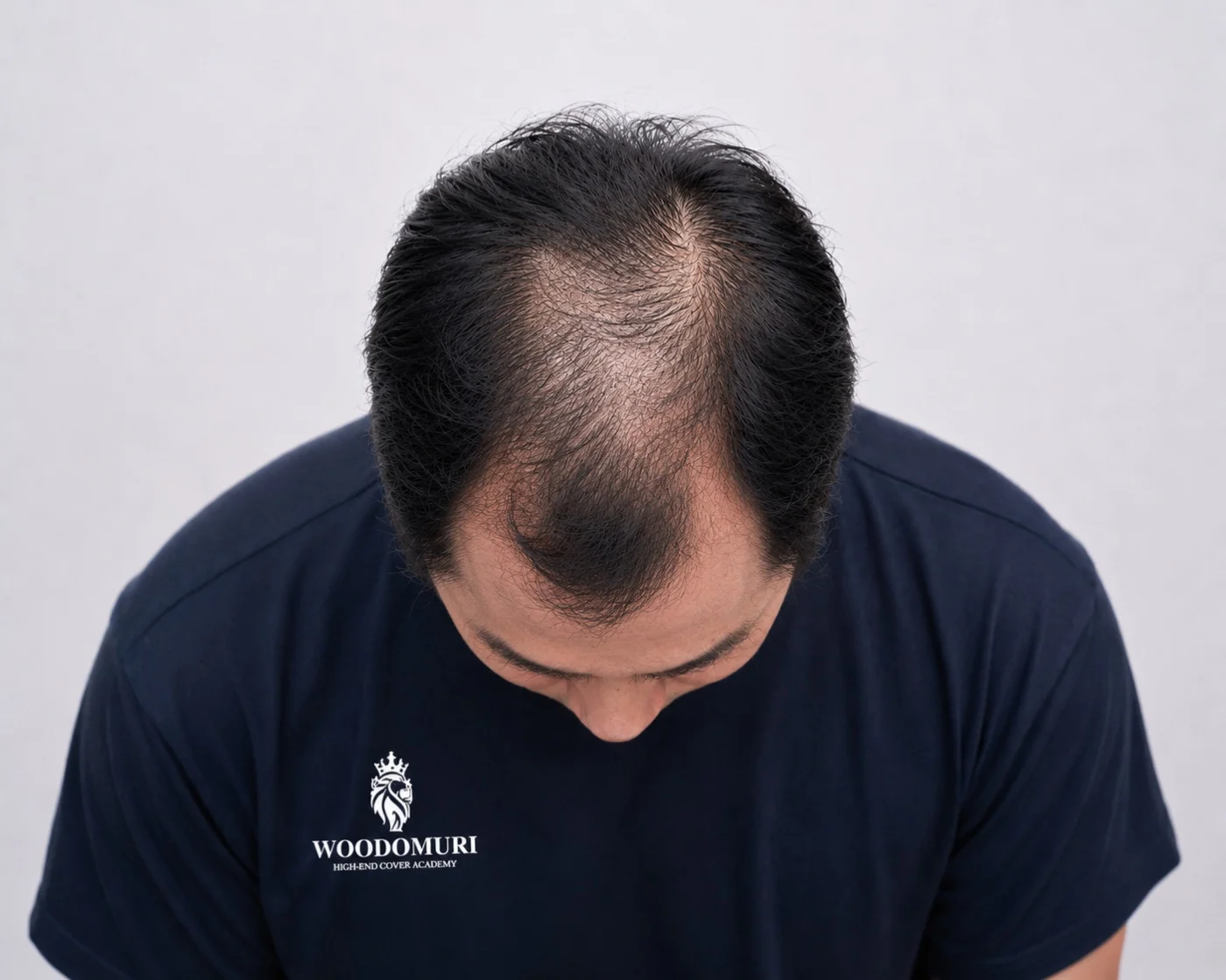 M자 헤어라인 — 시술 전 두피 상태