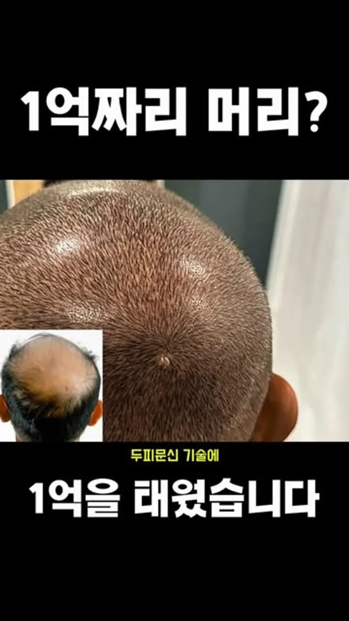 1억짜리 머리? 두피문신 기술에 1억을 태웠습니다