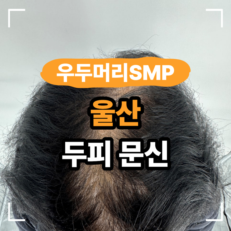 울산두피문신 대충 알아보고 결정하면 안되는 이유