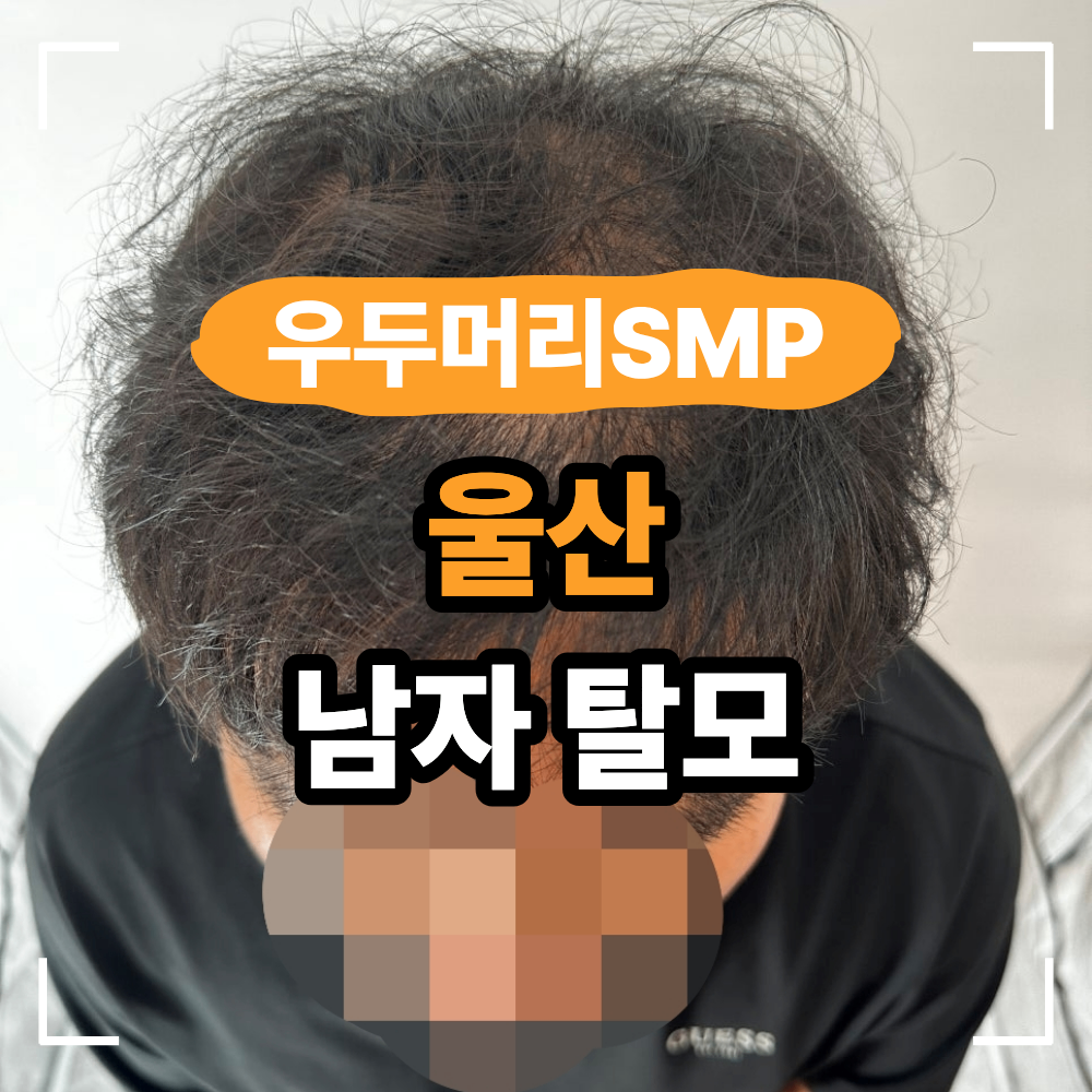 울산 남자 탈모 두피 문신 헤어라인 정수리 커버