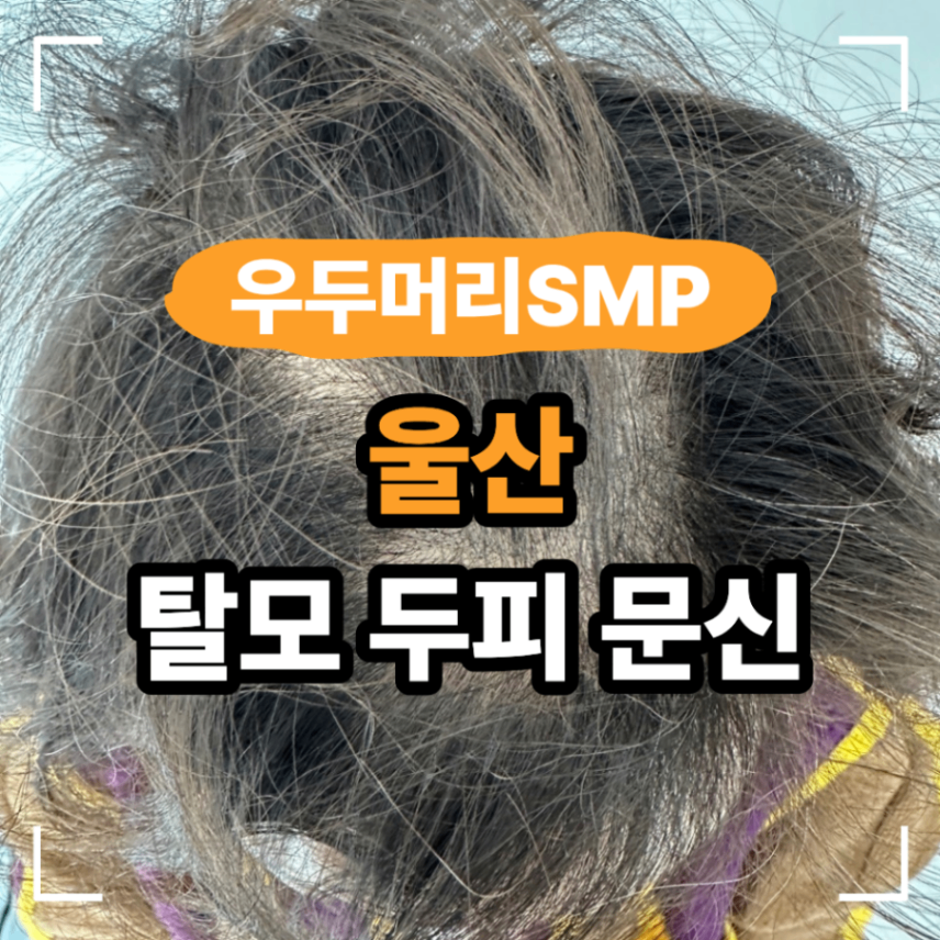 울산 동구 SMP 탈모 두피 문신으로 해결