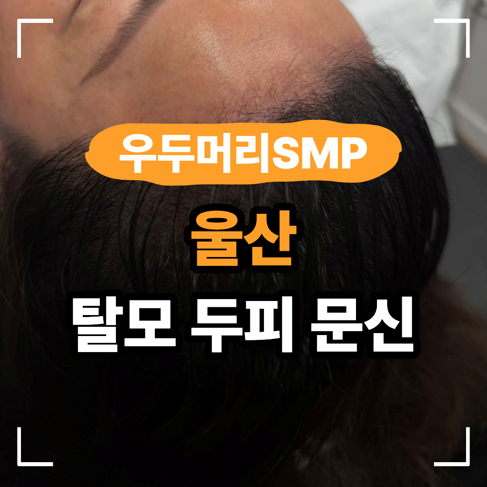 울산 중구 두피 문신 탈모 커버 방법 선택 기준