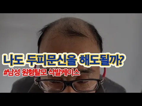[두피문신] 남성 원형탈모 삭발 케이스 (울산 우두머리 SMP 반영구 실제후기 내돈내산 창업 수강)